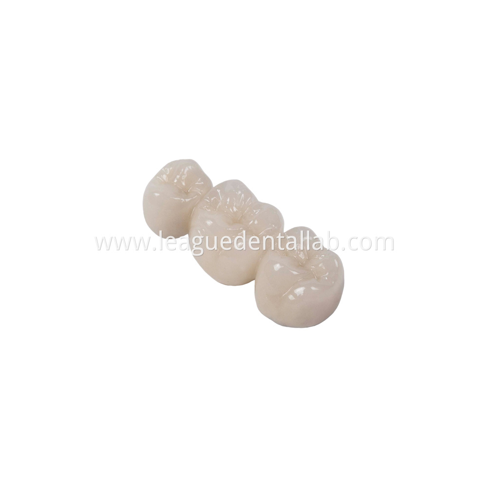 PFM,Metal crown,Fixed metal crown